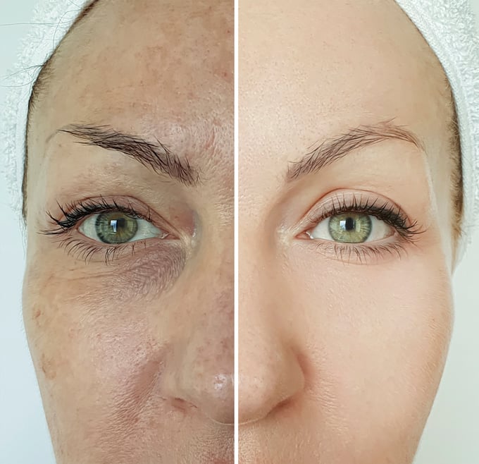 woman wrinkles face before and after treatment